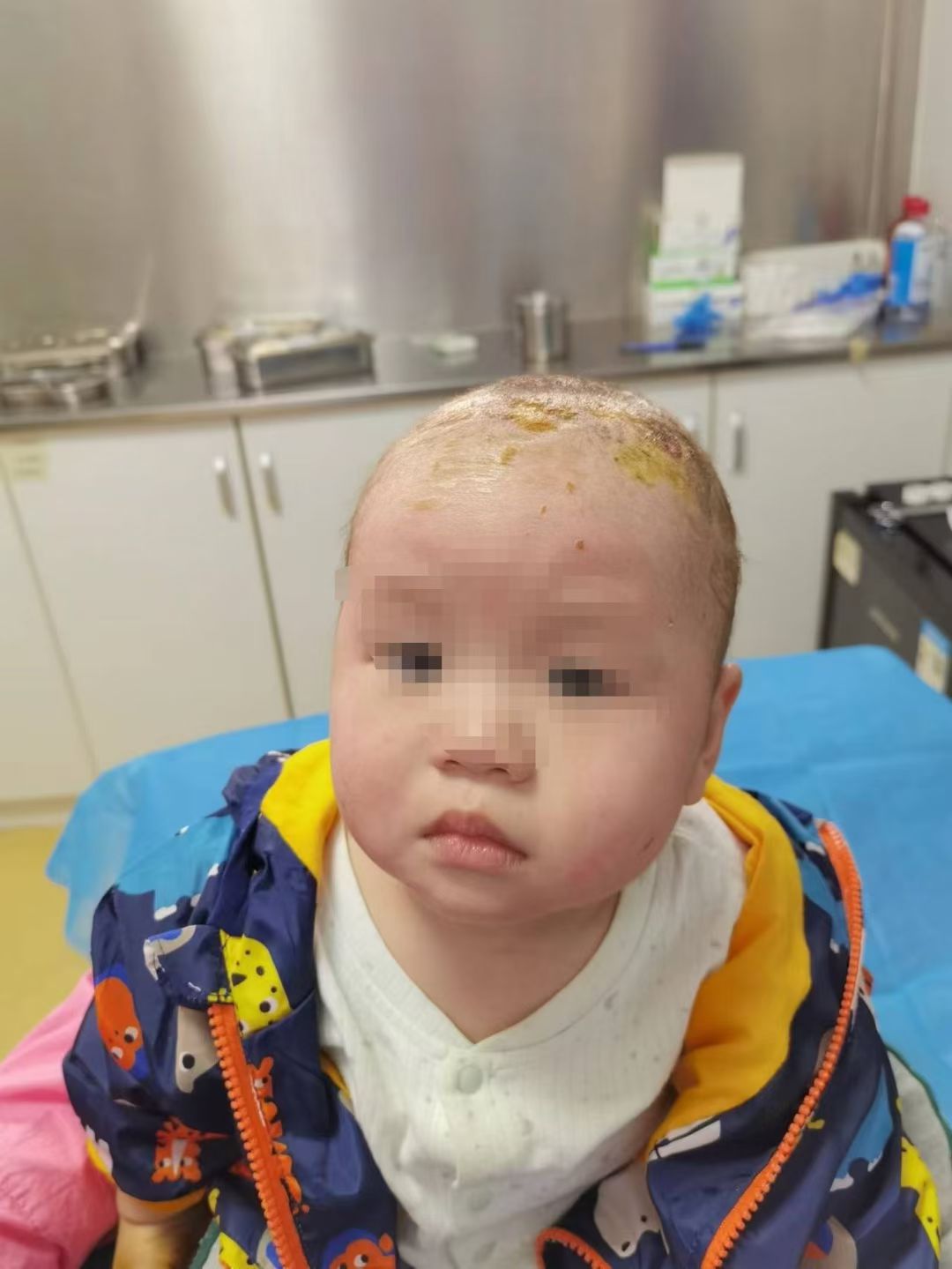 儿童面部烧伤修复案例 治疗后