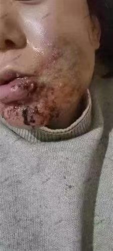 面部热油烫伤修复案例 治疗前