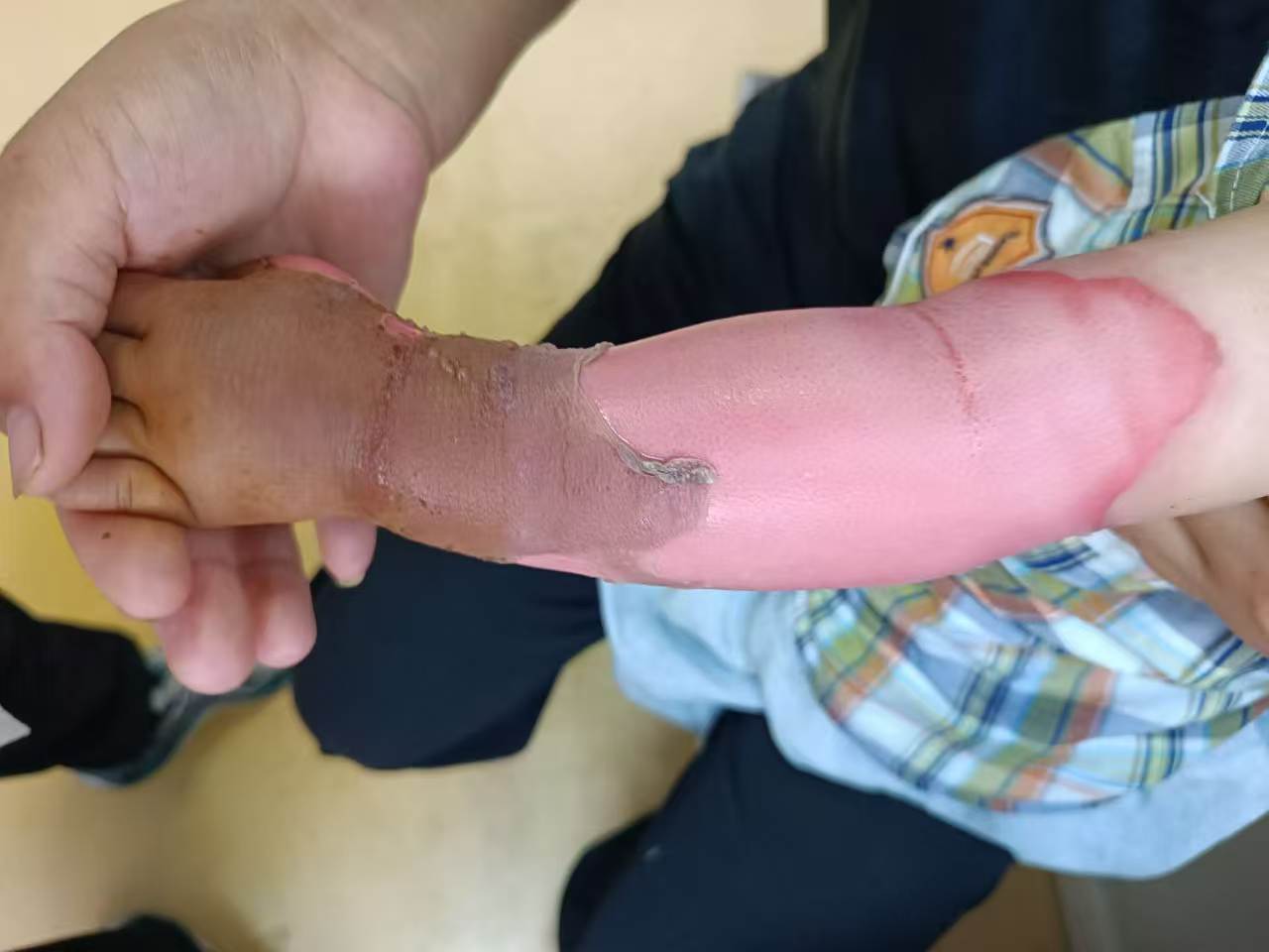 小朋友手部烫伤修复案例 治疗前