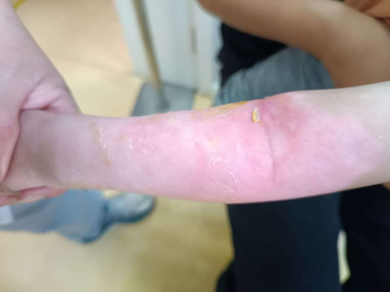 小朋友手部烫伤修复案例 治疗后