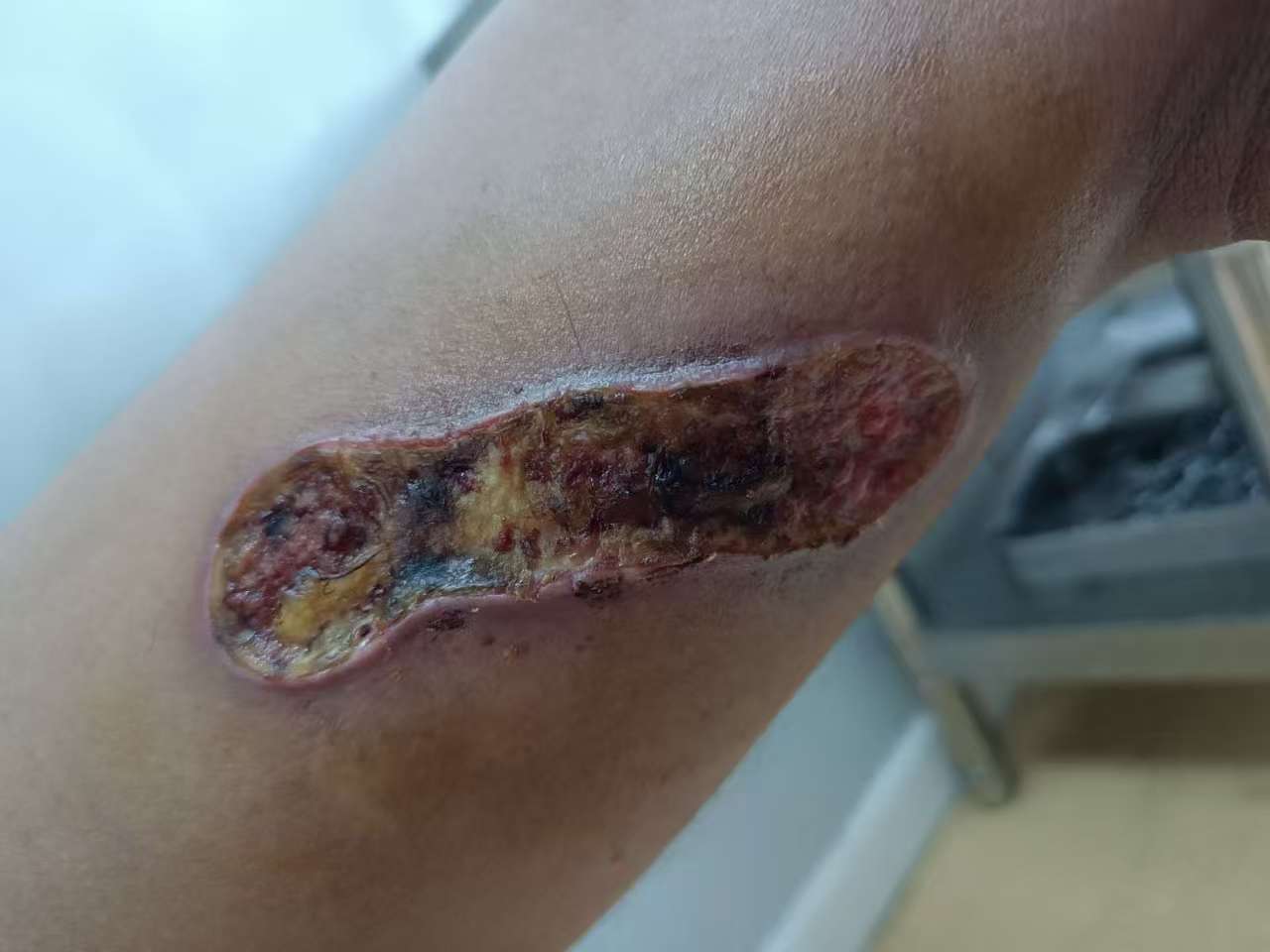下肢烫伤修复案例 治疗前