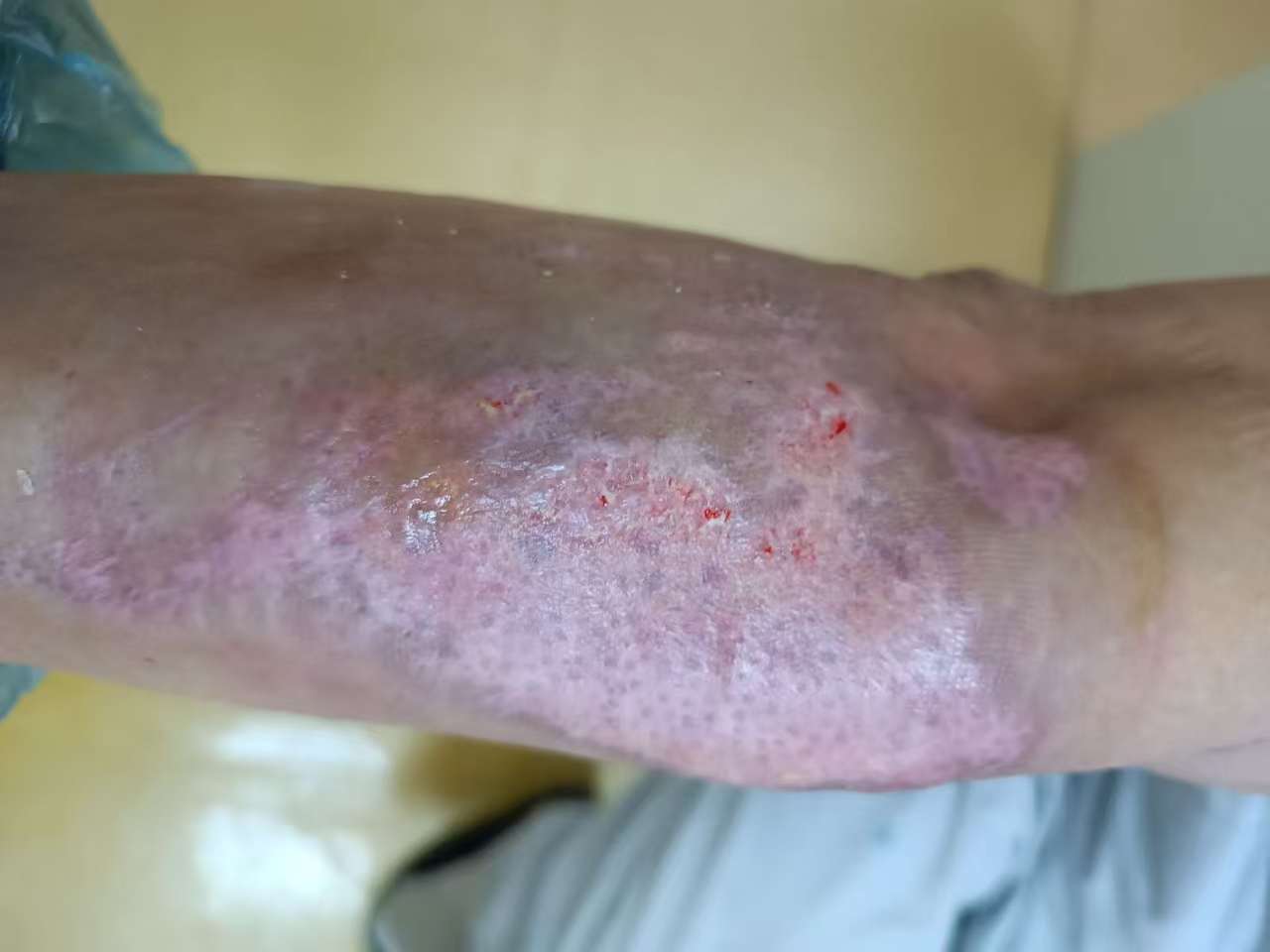 开水烧伤修复案例 治疗后