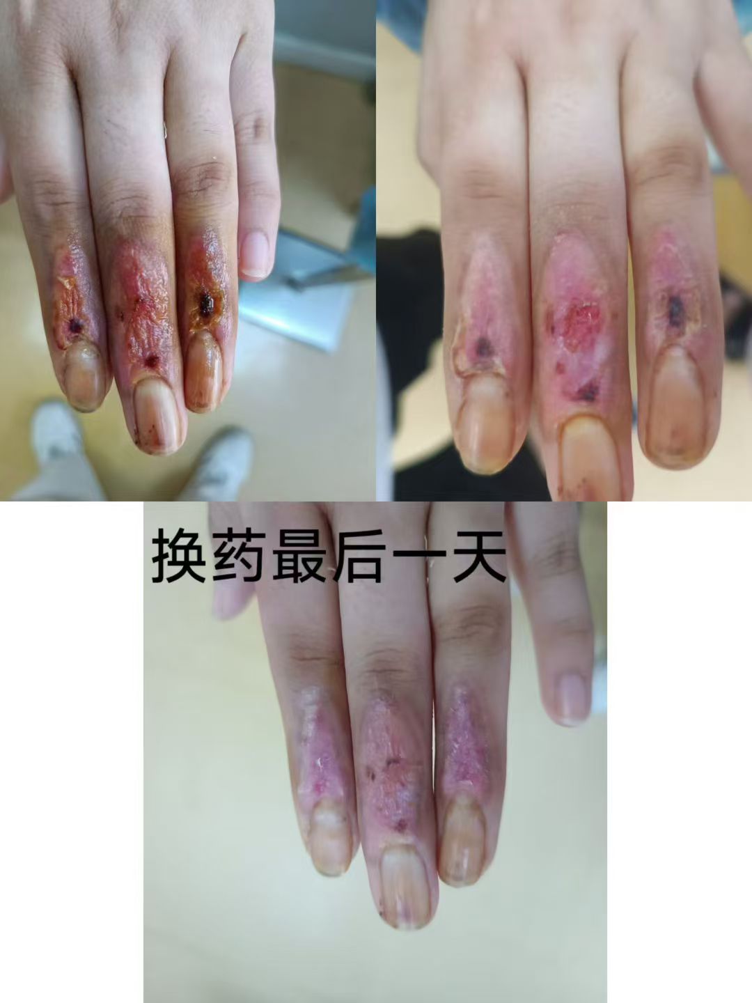 电烧伤创面修复案例 治疗后