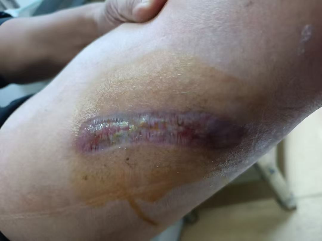 下肢烫伤修复案例 治疗后