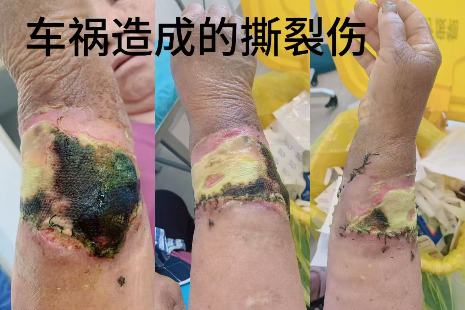 车祸造成的撕裂伤 治疗前